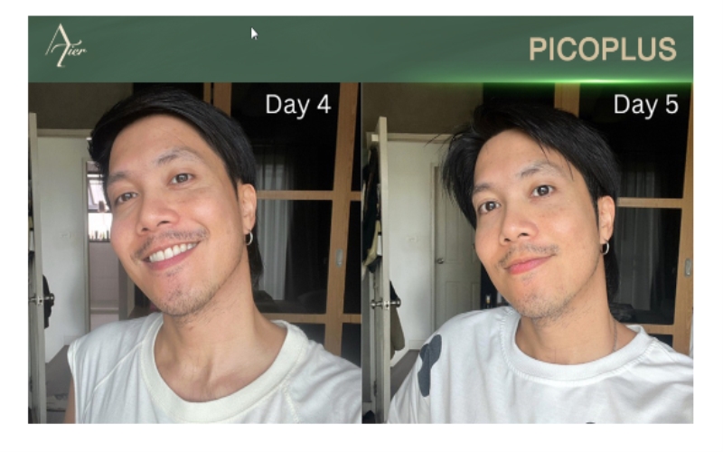 Picoplus Laser Skincare At Atier Wellness, Your Pathway to Smooth and Healthy Skin